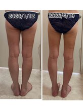 クールスパ(COOL SPA)/40代女性 脚症例