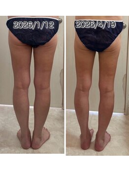 クールスパ(COOL SPA)/40代女性 脚症例
