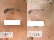 プルミエビューティー(1er Beauty)の雰囲気（≪美白シミケア≫目元のシミもしっかりケア！ダウンタイム無し！）