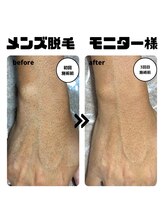 ザ サロン(THE SALON)/結果重視！メンズ脱毛