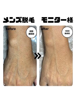 ザ サロン(THE SALON)/結果重視！メンズ脱毛