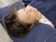 ビースタイル(B-style)/【美容鍼灸】電気美容鍼灸施術