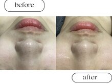 ルボン(RUBON)/ピーリング＋毛穴洗浄