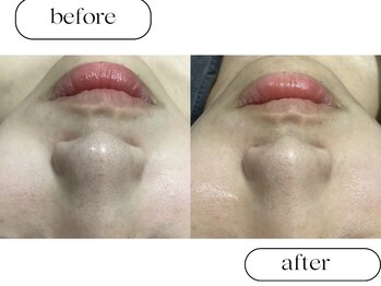 ルボン(RUBON)/ピーリング＋毛穴洗浄