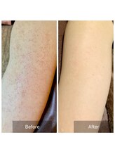 ビビ(VIVI)/ハーブピーリング腕のブツブツに