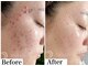 ビースキン 藤沢店(BeSkin)の写真/毛穴肌質改善【肌荒れ/ニキビケア/毛穴/乾燥/敏感肌】などの様々なお悩みに！栄養成分を肌の深部へ♪