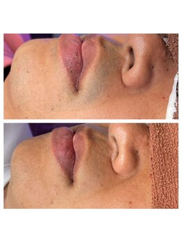 プルメリア(Plumeria)/脱毛開始半年経過