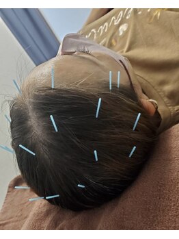 ベレディオ鍼灸整骨院(Belledio鍼灸整骨院)の写真/【最高の組み合わせ★美頭鍼×ヘッドマッサージ】硬くなった頭皮を美頭鍼で血行促進、頭痛・眼精疲労にも◎