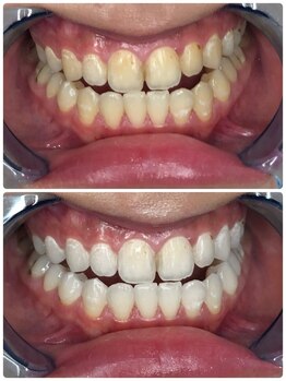 エール(aile)/うるま市セルフホワイトニング