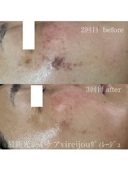プライベートアイラッシュサロン ヴィレージュ 稲毛店(Vireijou)/大人女性のシミケアコース