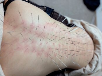 鍼灸院 虹の写真/[ルート鍼新導入]★繰り返す痛みを改善したい方おすすめ◎ルート鍼で深層のコリから徹底アプローチ♪