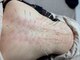 鍼灸院 虹の写真/[ルート鍼新導入]★繰り返す痛みを改善したい方おすすめ◎ルート鍼で深層のコリから徹底アプローチ♪