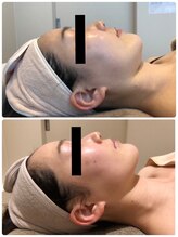 エイシスグロウ(asis glow.)/効果写真