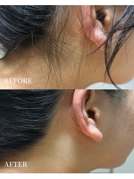 エース(ACE.)/人気アップ☆うなじ脱毛