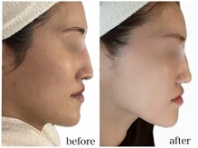 サロンドール(Salon doll)/ハーブピーリング