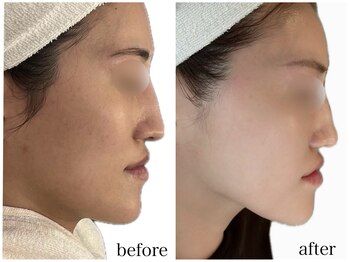 サロンドール(Salon doll)/ハーブピーリング