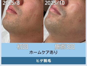 アロマ(AROMA)/ニキビ×ヒゲ脱毛が同時に叶う