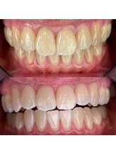 エール(aile)/うるま市セルフホワイトニング