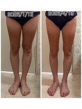 クールスパ(COOL SPA)/40代女性 脚症例
