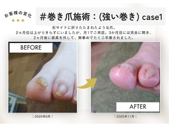テネシー/#巻き爪施術:(強い巻き) case1