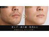 【メンズ人気No.1】 清潔感UP◆青ヒゲ・肌荒れ改善ヒゲ脱毛