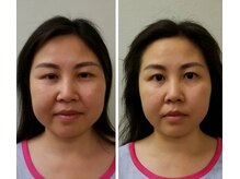 アゴラ/【小顔】【中国での実績もあり】