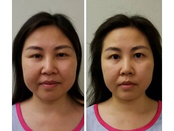 アゴラ/【小顔】【中国での実績もあり】