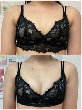 バーディー(BIRDIE)/施術３回/２０代ママ/A→C