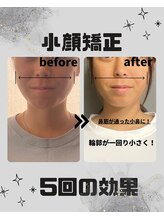 めいてる/小顔矯正/疲れ顔/大阪市