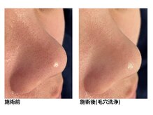 オーシャンブルー 長崎店(OCEAN BLUE)/毛穴の黒ずみケア（毛穴洗浄）