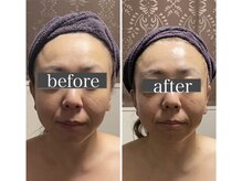 小顔アンドエイジングケア専門店 ビゼ(美sser)/美sser小顔コルギ