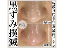 リアン(Riant)/毛穴ケアコース 