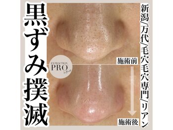 リアン(Riant)/毛穴ケアコース