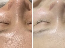 マリヴェリーテ(Mari verite)/ブライダルを綺麗な肌で迎えたい