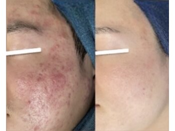 ムーンリズム(Moonlism)/【TIPハーブ症例】ニキビ・跡