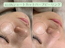 【韓国Medicalエステブランド】ショートカットハーブピーリング