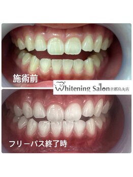 ホワイトニングサロン 京都烏丸店/ホワイトニングサロン施術例　