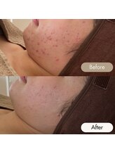 メイクス(Makes)/剥離なし♪漢方ハーブ