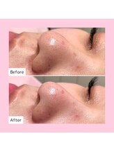 ホワイトラボ ライカム前店(White labo)/【施術例】毛穴洗浄ピーリング