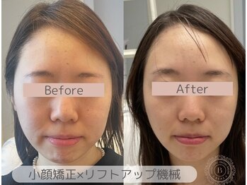 ベアール(beal)の写真/【初回半額】フェイスラインが上がるとブライダルからも絶賛◎ハンド×最新リフトアップ機器の本格小顔ケア
