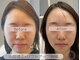 ベアール(beal)の写真/【初回半額】フェイスラインが上がるとブライダルからも絶賛◎ハンド×最新リフトアップ機器の本格小顔ケア