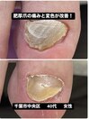 肥厚爪による痛みと変色が改善