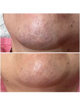 リンク(LiNK)/脱毛とシェービング