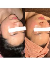 ヴィーナス(Venus)/白玉スキンフェイシャル