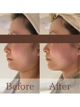 凪眠/小顔リンパフェイシャルの効果65