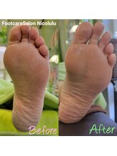 ニコルル 高崎パルクハナミズキ店(Nicolulu)/かかとのガサガサ