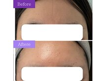 フェイシャルケアで額も丸くふっくらに♪若々しく華やか印象に