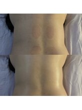 ララルアナ(Lara luana)/バザルトで背中のむくみを撃退