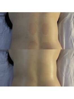 ララルアナ(Lara luana)/バザルトで背中のむくみを撃退