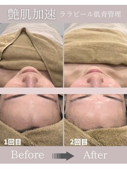 サロンフロム つくば店(Salon From)/◆肌育ララピールフェイシャル◆